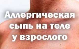 Экзантема аллергическая